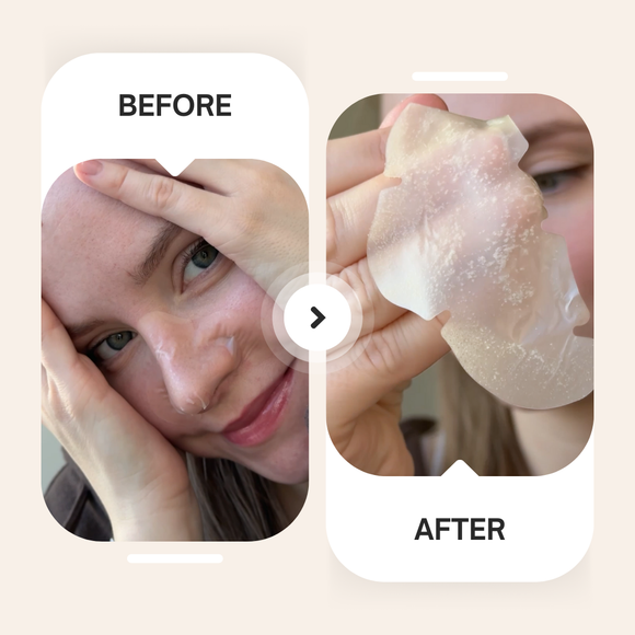 Spotted Pores - Hydrocolloid Nose Patches